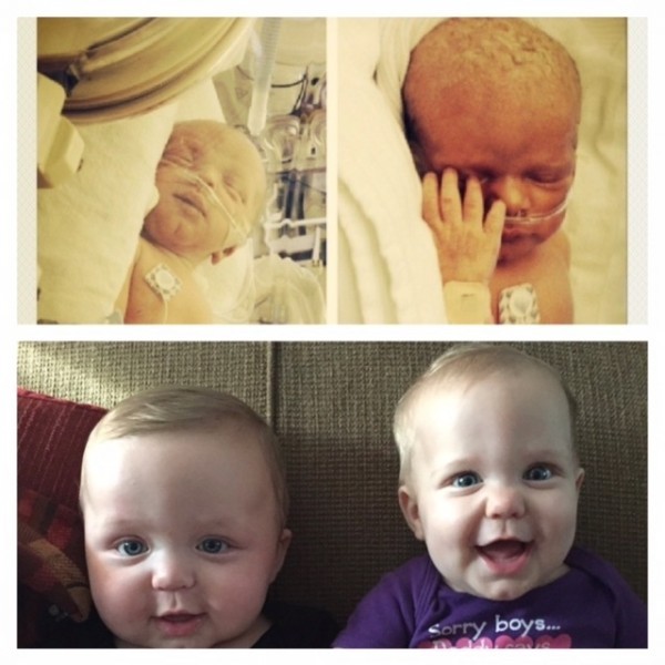 "Вот мои близнецы Кейси и Клэр Катерино в 34 недели и сегодня в 7 месяцев"