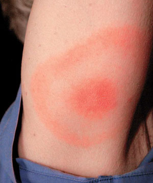 боррелиоз, мигрирующая эритема, болезнь Лайма