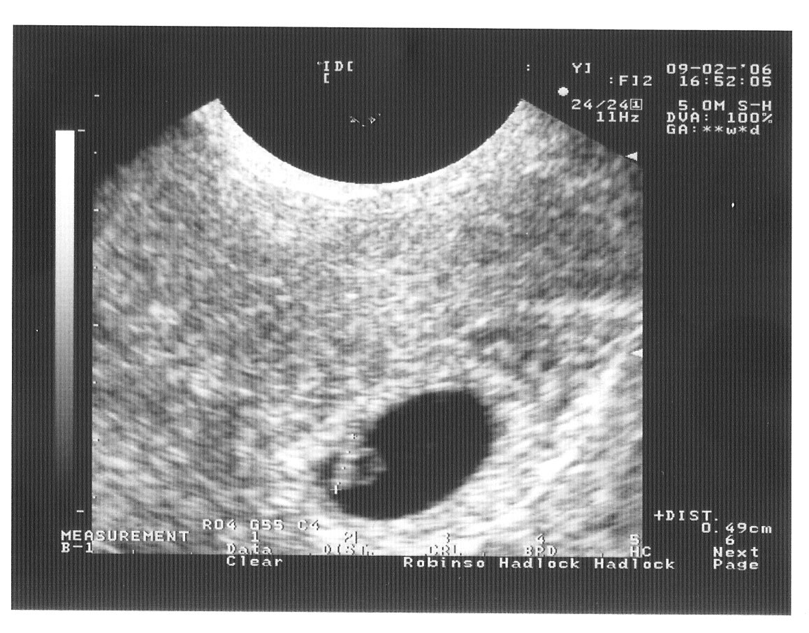 Как выглядит узи на 6 неделе. УЗИ 6.6 недель беременности. УЗИ на 6 акушерской неделе. Зи в 6 недель беременности.