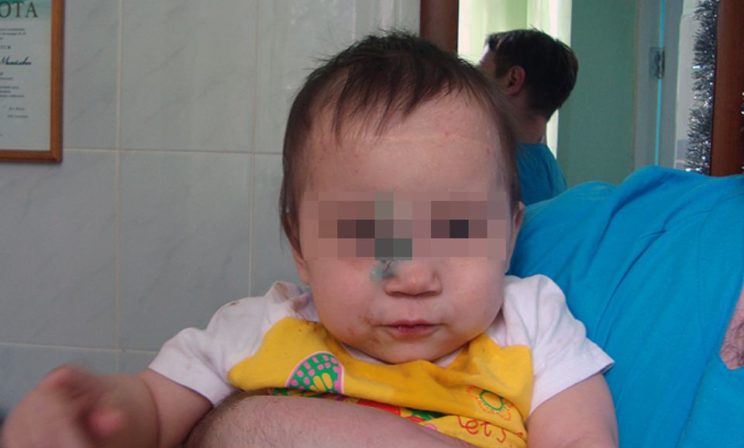 Красноярский нейрохирург сделал уникальную операцию, чтобы спасти смертельно больного ребенка