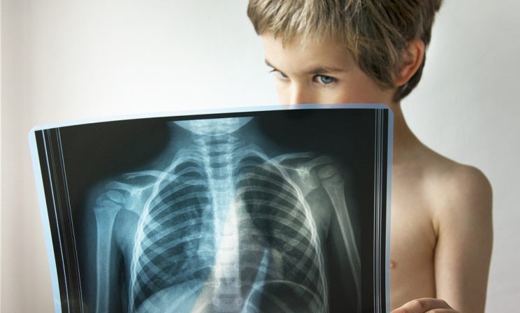 туберкулез