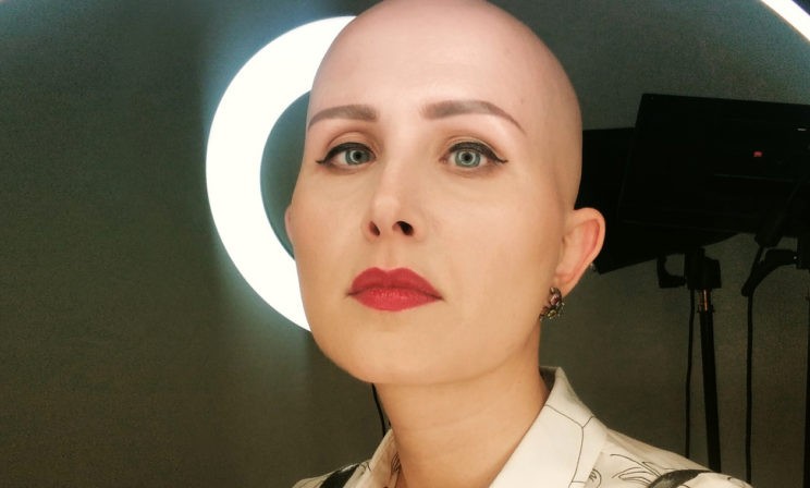 Целая страна лысых женщин. Как живут люди с алопецией