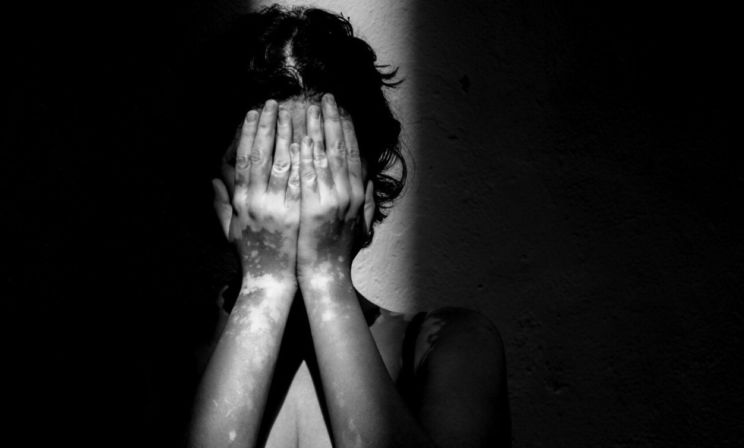 «А вы точно не заразны?» - спросил врач. Как живут люди с редкими болезнями кожи