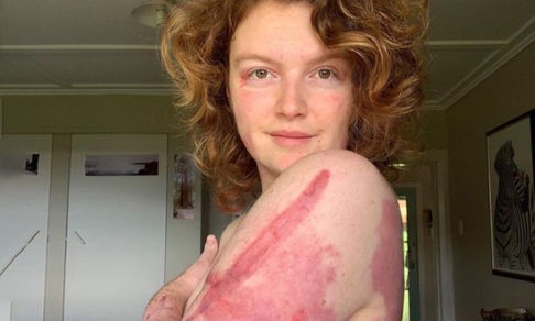 Вулкан обжег половину ее кожи. Но 28 незнакомцев сдали кровь и Келси выжила