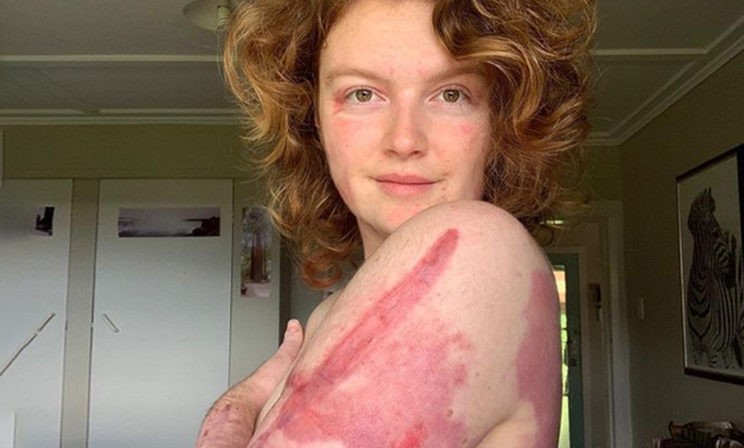 Вулкан обжег половину ее кожи. Но 28 незнакомцев сдали кровь и Келси выжила