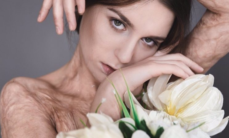 Света Уголек: «А внутри я вся переломанная». История модели с ожогами 45% тела