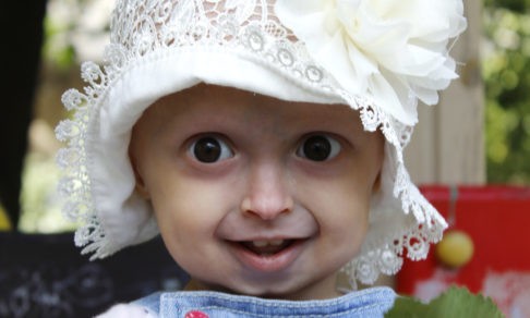 Мелания перестала расти. В 2 года она весит как младенец