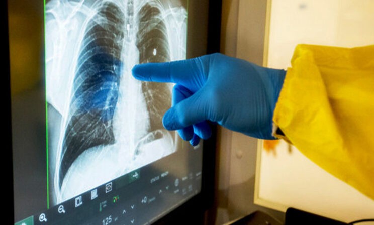 После ковида риск туберкулеза выше — что это значит? Объясняет фтизиатр Анна Белозерова