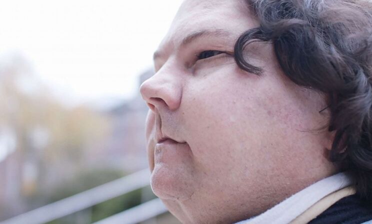 «Мне пересадили чужое лицо». Как Джо выжил после автокатастрофы и ожогов 80% тела