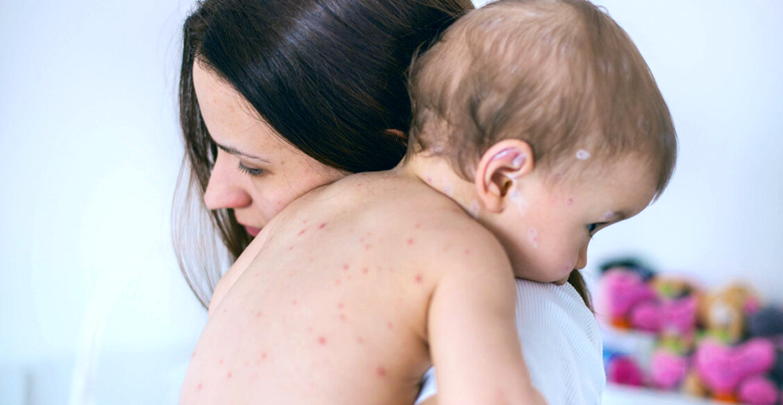 Не привились от кори из-за пандемии. Чем это грозит?