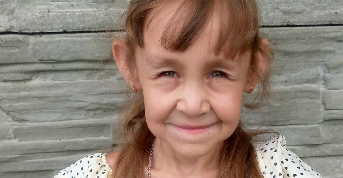Ангелина в 7 лет выглядит старше своей мамы. У девочки синдром «вялой кожи»