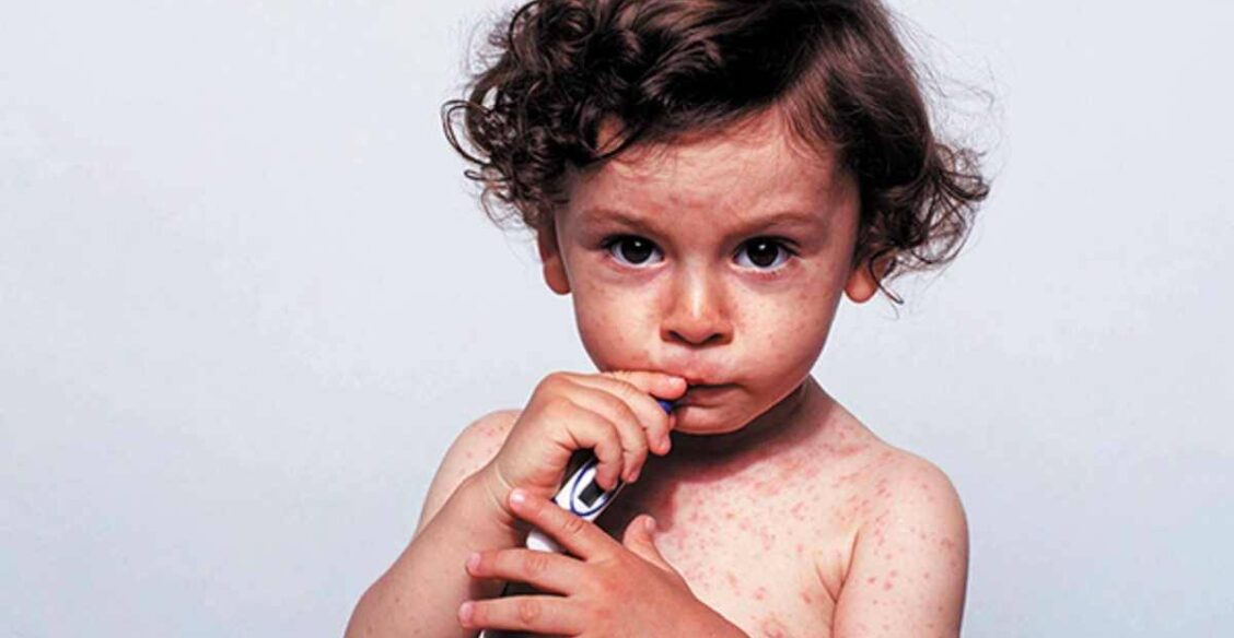 Почему опасна корь