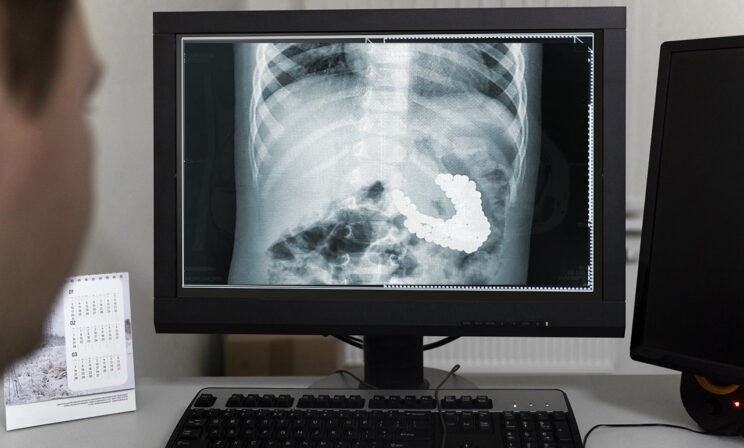 Полуторагодовалый ребенок съел 130 магнитов и батарейку. Врачам удалось его спасти