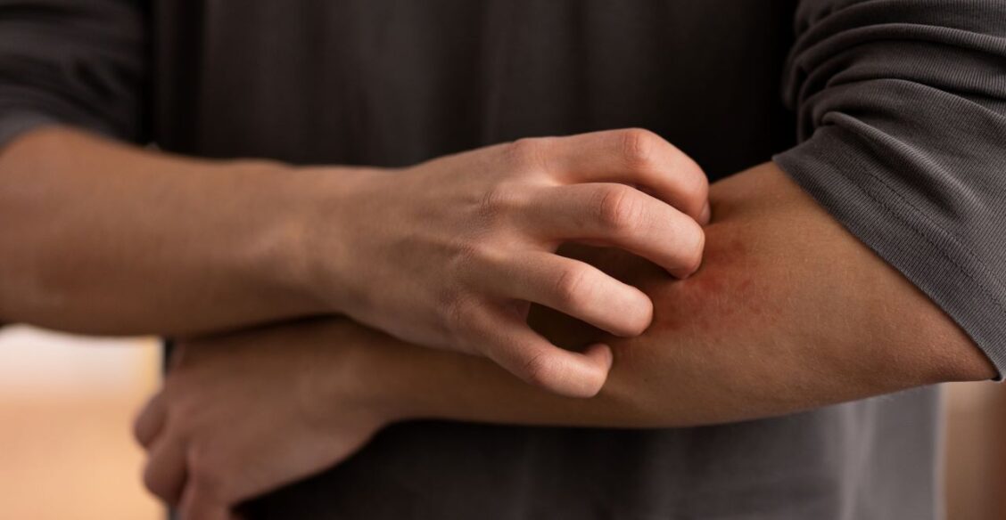 Вирусологи предупредили о риске завоза лихорадки чикунгунья в Россию