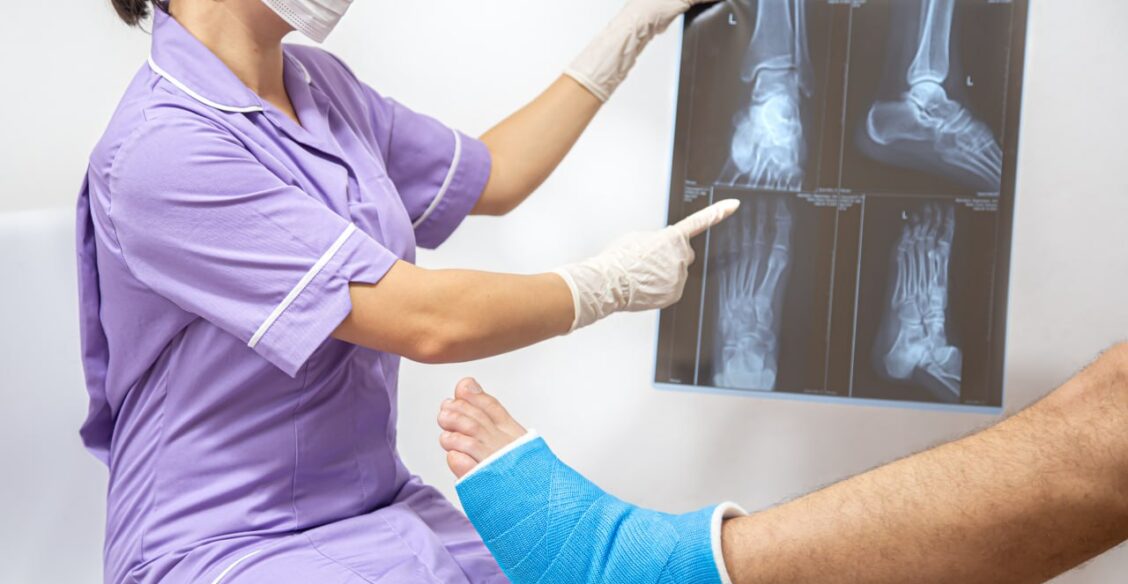 Китайские ученые разработали «костный клей», заживляющий переломы за минуты