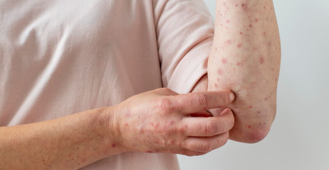  Случай оспы обезьян подтвержден у россиянина