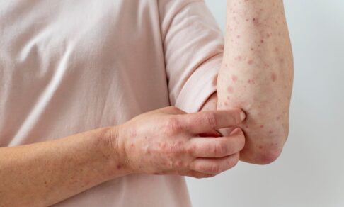  Случай оспы обезьян подтвержден у россиянина