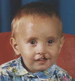 Развитие ребенка с расщелиной губы